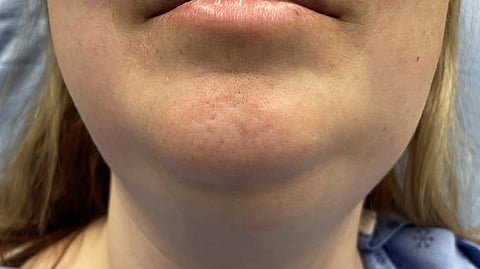A female patient with swelling on both sides of the jaw.