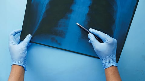 person holding an x ray result 
