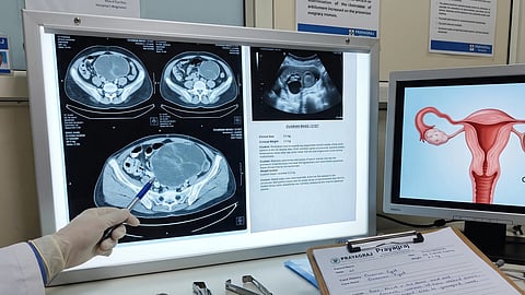 Ovarian cyst scans on a screen