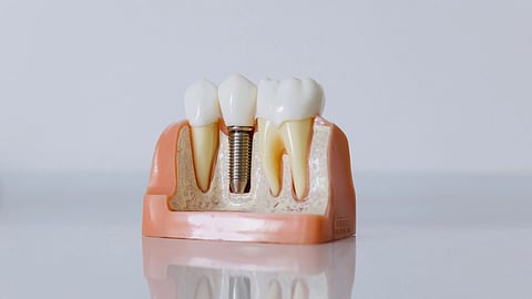A dental implant with medical jaw and teeth embedded.