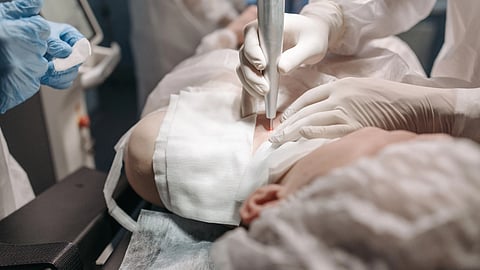 A woman lying down and a surgeon using a tool for a cosmetic procedure on her.