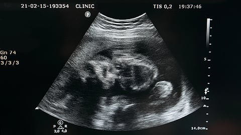 Ultrasound scan showing the image of an unborn child in the womb