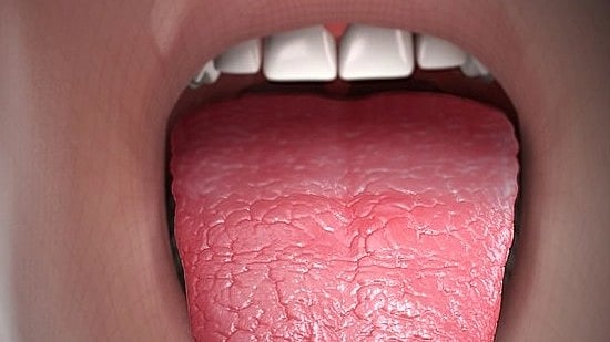Xerostomia Dry Mouth Causes, Symptoms And Treatment