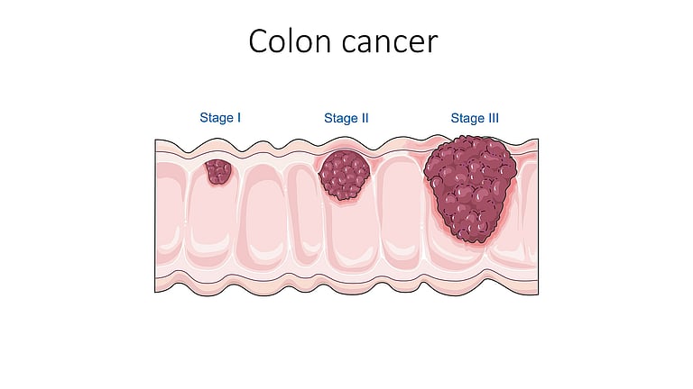 Experts Urge Colon Cancer Awareness to Reverse Decline in Screening ...