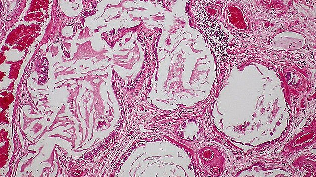 Molecule Known To Slow Inflammation Linked To Scleroderma, Could Be ...