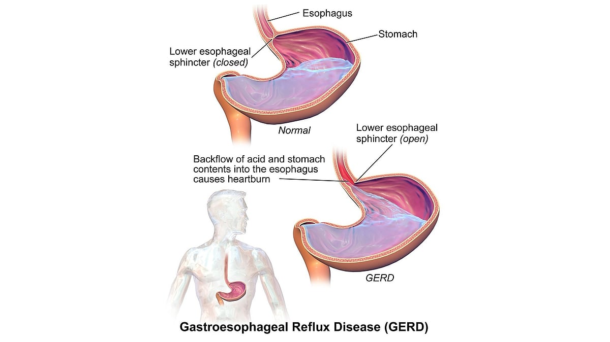 What is GERD and How Can It Be Managed? A Viewpoint from a Primary Care ...