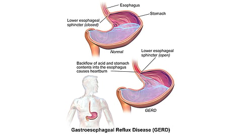 What is GERD and How Can It Be Managed? A Viewpoint from a Primary Care ...