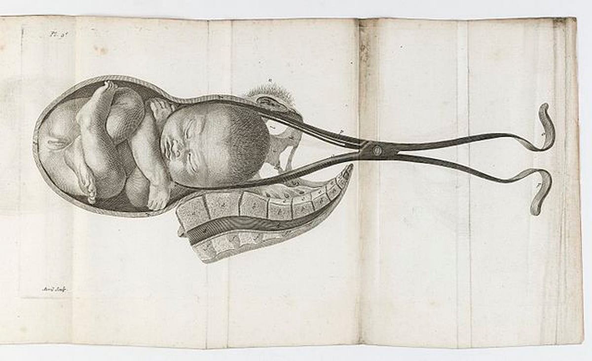 The Child Extractor-History & Evolution of the Obstetric Forceps