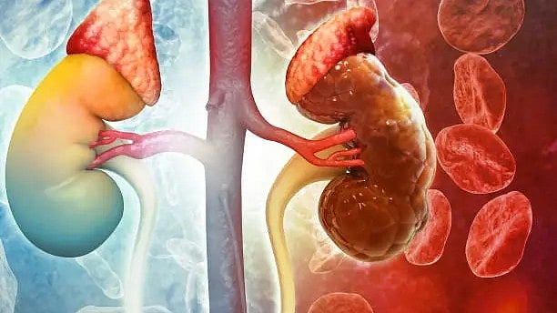 Research Analyzes Kidney Functions and Predictors of Disease