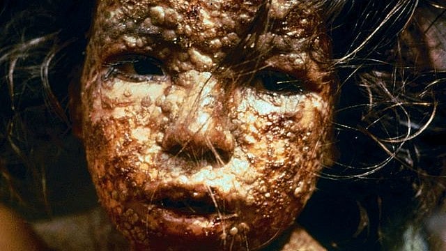 What I Learned From the World’s Last Smallpox Patient