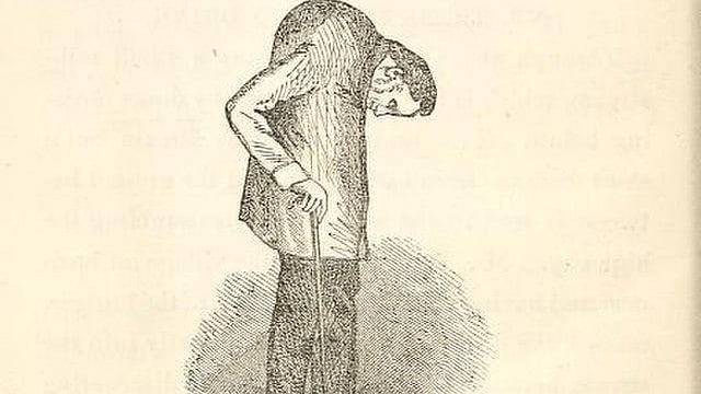 “Folded Man” with Ankylosing Spondylitis Stands Up After 28 Years