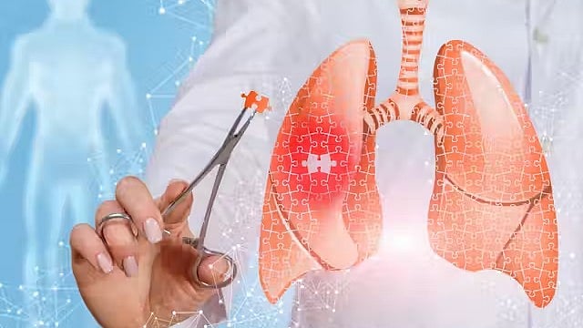 New Guidelines Aim to Improve Cystic Fibrosis Screening
