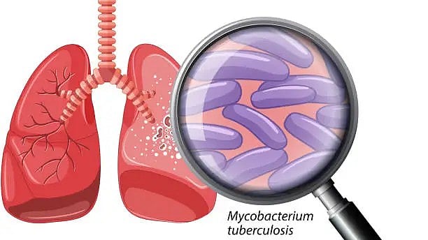 Hope On The Horizon For Tuberculosis