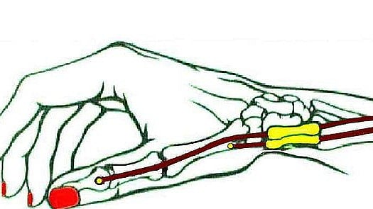 Manage De Quervain’s Syndrome at Home: Tips & Tools for Relief