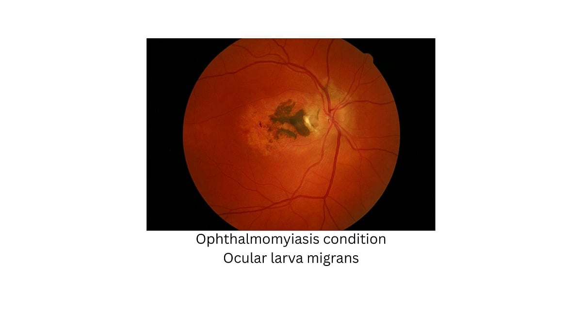 Tiny Eye Larvae Infestation: Symptoms, Diagnosis & Treatment