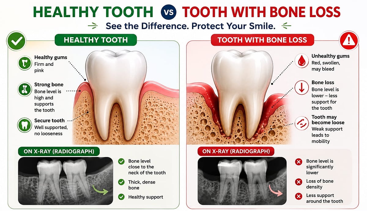 Dental Bone Loss: What It Means, How It Progresses, What You Can Do?