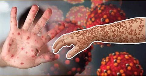 ২৪ ঘণ্টায় দেশে হামের উপসর্গে ৪ জনের মৃত্যু, আক্রান্ত ৬৮৫: স্বাস্থ্য অধিদপ্তর