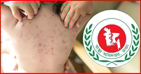 ২৪ ঘণ্টায় হাম ও হামের উপসর্গ নিয়ে ৮ জনের মৃত্যু