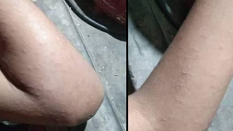 വെഞ്ഞാറമൂട് സർക്കാർ സ്കൂളിൽ നൂറോളം വിദ്യാർ‌ഥികൾക്ക് ചൊറിച്ചിലും ശ്വാസം മുട്ടലും; പകർച്ചവ്യാധിയെന്ന് സംശയം