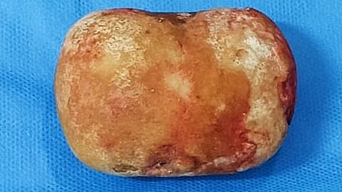 യുവാവിന്‍റെ മൂത്രാശയത്തിൽ നിന്ന് നീക്കം ചെയ്ത കല്ല്.