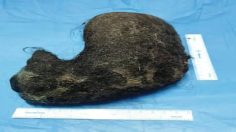 കുട്ടിയുടെ വയറ്റിൽ നിന്നും പുറത്തെടുത്ത മുടി