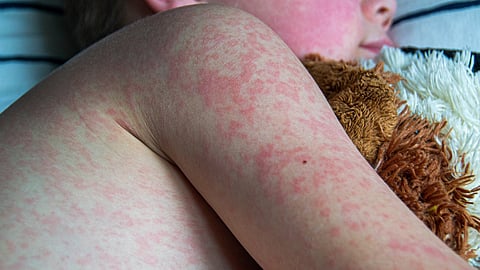 measles spread in usa