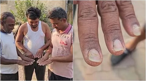 After hair loss, nails also fall off.