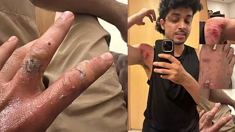 actor sagar surya injured during shooting of the movie prakambhanam