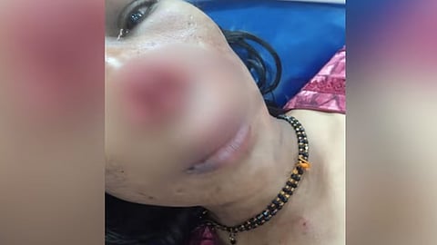 Man bites wife's nose off