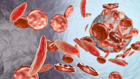 Sickle cell disease eradication mission enters new phase