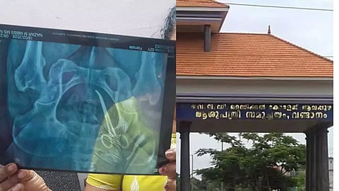 Scissors in the stomach of an elderly woman