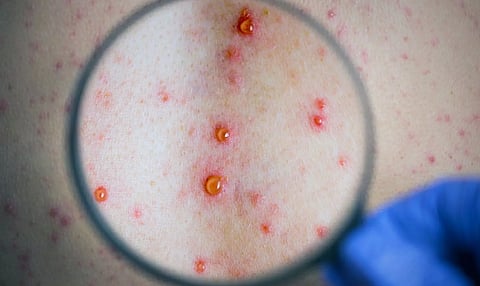 Mpox outbreak: 4 infected infants dead in Pak's Sindh