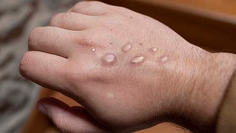 Detectan los primeros casos de viruela del mono en niños, en EU