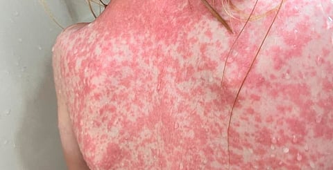 Brote de sarampión en EU deja tres muertos y más de mil contagios en 2025