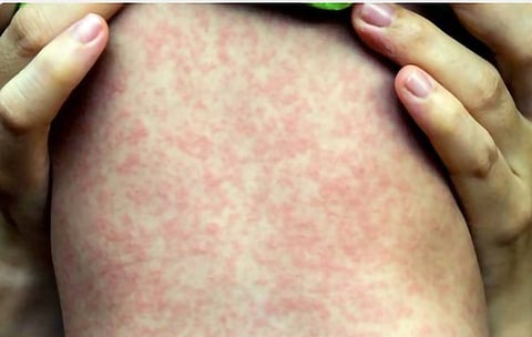 Michoacán, sin repunte de casos de sarampión, asegura SSM