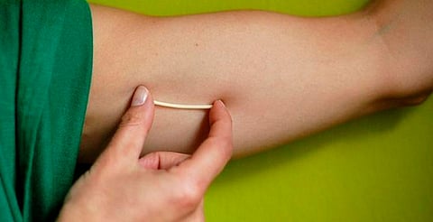 ¿Vives en Pátzcuaro? Podrás colocarte el implante anticonceptivo ¡gratis!