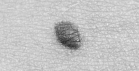 En piel morena, puede parecer una mancha oscura brillante