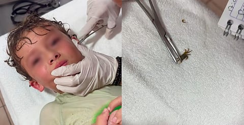 ¡Vacaciones de terror! Extraen cangrejo del oído de un niño [VIDEO]