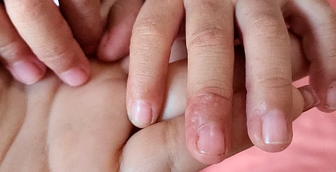 En septiembre, 10 niños de preescolar en Morelia enfermaron por coxsackie