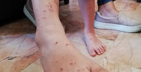 ¡Ojo! México registra más de mil casos de varicela en una semana