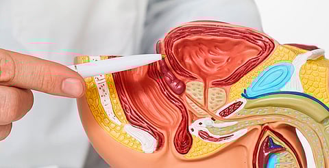 Lo que tu cuerpo advierte; síntomas clave del cáncer de próstata