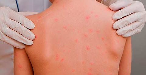 Confirman primer caso importado de sarampión en México