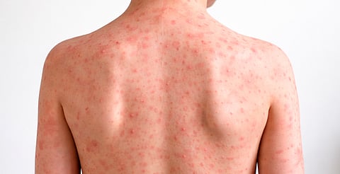 Michoacán, entre los estados con más casos de sarampión; vacunación, la clave