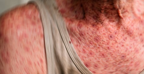 Hombre de 64 años, primera víctima de sarampión en Michoacán; no estaba vacunado