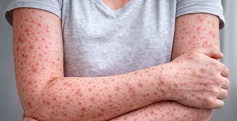 Sin uso obligatorio de cubrebocas, Michoacán contiene casos de sarampión: SSM