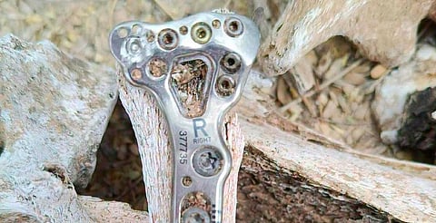 Hallan restos y una placa quirúrgica que podría dar nombre a una víctima