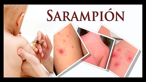 La infección causada por el virus del Sarampión produce una enfermedad aguda, la cual es altamente contagiosa