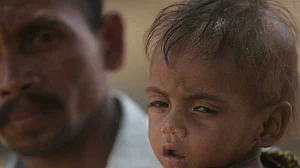 BJP-ruled states high on malnutrition index