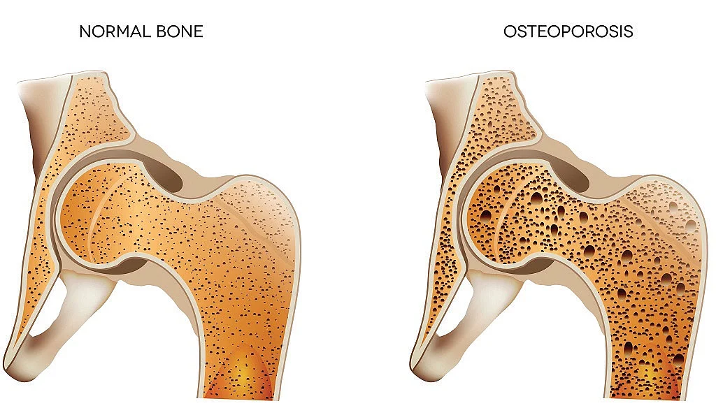 Doctor’s blog: Diagnosing Osteoporosis is a fashionable trend, a medical fad