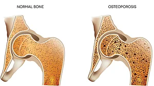 Doctor’s blog: Diagnosing Osteoporosis is a fashionable trend, a medical fad